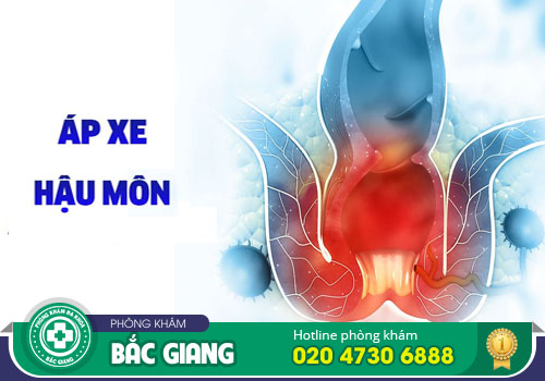 Những điều cần biết về apxe hậu môn