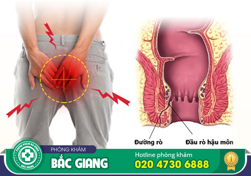 Rò hậu môn là bệnh gì? Có nguy hiểm không?