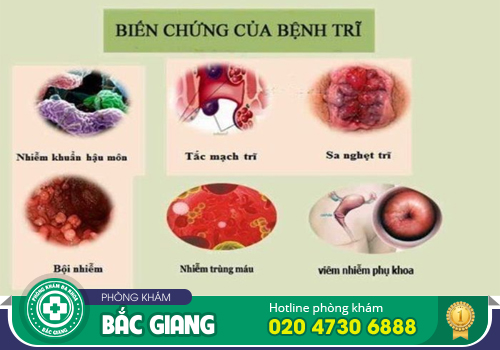 Tổng hợp biểu hiện bệnh trĩ nội, trĩ ngoại và cả trĩ hỗn hợp dễ biết