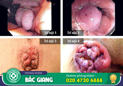 Tổng hợp biểu hiện bệnh trĩ nội, trĩ ngoại và cả trĩ hỗn hợp dễ biết