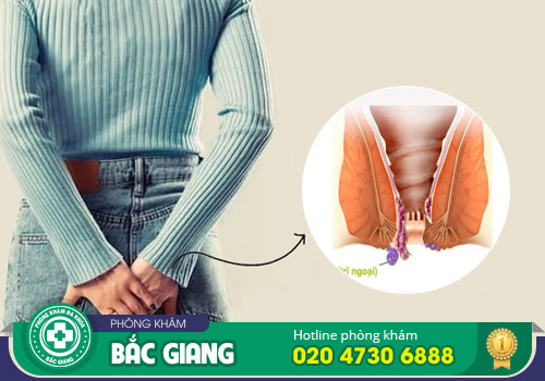 Bệnh trĩ ngoại: nguyên nhân, triệu chứng và cách điều trị hiệu quả