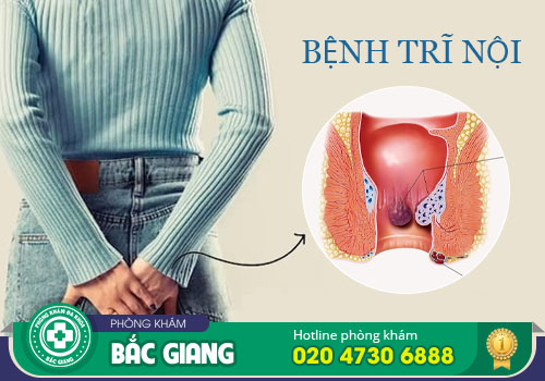 Bệnh trĩ nội và những điều bạn cần biết