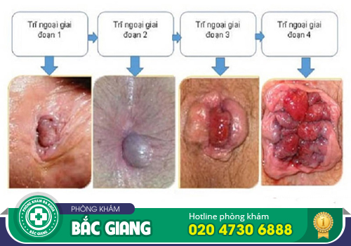 Tổng hợp biểu hiện bệnh trĩ nội, trĩ ngoại và cả trĩ hỗn hợp dễ biết