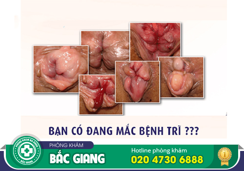 Tổng hợp biểu hiện bệnh trĩ nội, trĩ ngoại và cả trĩ hỗn hợp dễ biết