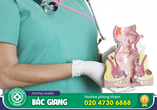 Tìm hiểu biểu hiện trĩ để nắm rõ khả năng mắc bệnh