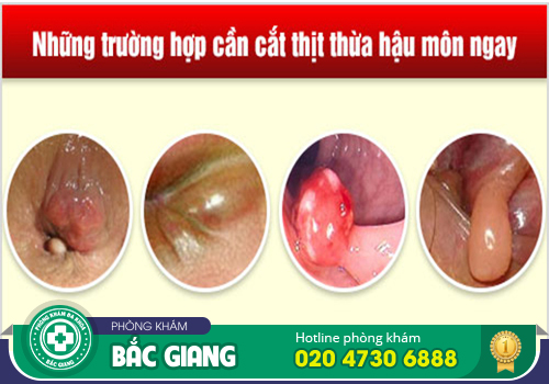 Có nên cắt da thừa hậu môn không?