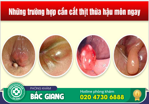 Chi phí cắt da thừa hậu môn bao nhiêu? Bao lâu lành?