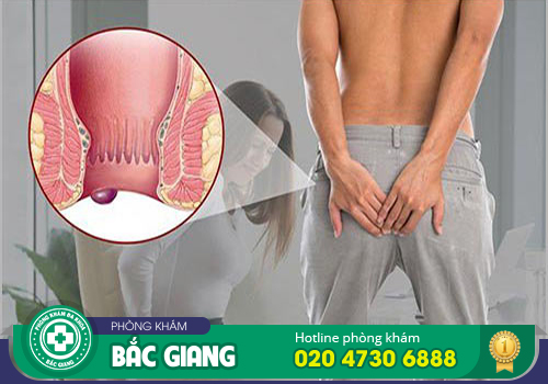 Cắt thịt thừa ở hậu môn bằng phương pháp nào hiệu quả?