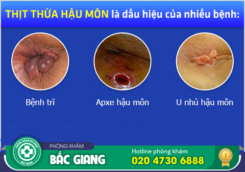 Da dư hậu môn là bệnh gì? Có nguy hiểm không?