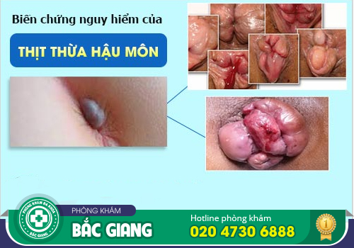 Da dư hậu môn là bệnh gì? Có nguy hiểm không?