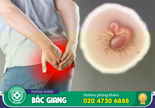 Da dư hậu môn là bệnh gì? Có nguy hiểm không?