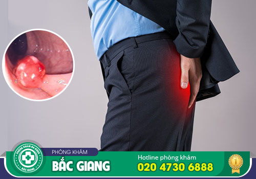Polyp hậu môn là bệnh gì? Phương pháp chẩn đoán điều trị polyp hậu môn hiệu quả
