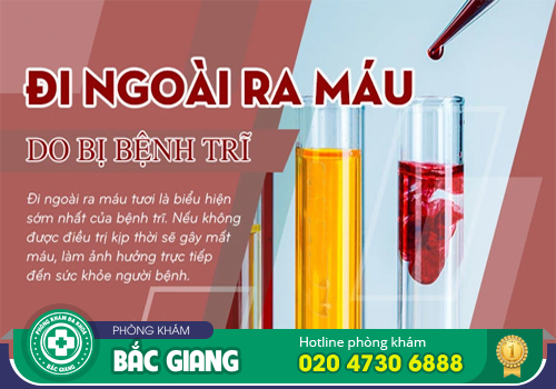 Đi ngoài ra máu - Dấu hiệu điển hình khi bị trĩ