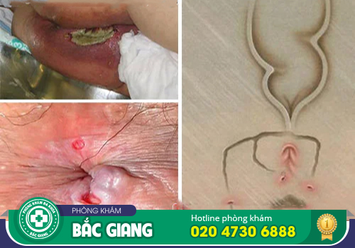 Mổ mạch lươn có nguy hiểm không?