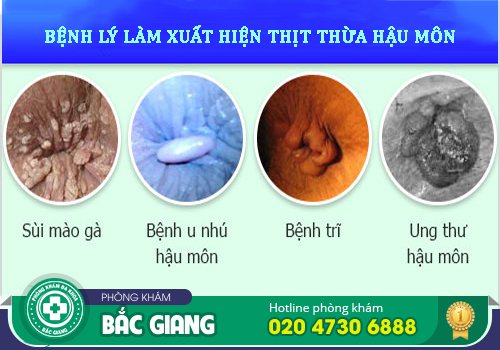 Điều trị thịt dư ở hậu môn bằng cách nào?