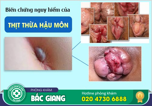 Địa chỉ khám chữa thịt thừa uy tín, có bác sĩ chuyên khoa giỏi