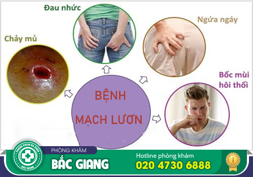 Nguyên nhân bệnh mạch lươn - Triệu chứng và phương pháp hỗ trợ điều trị