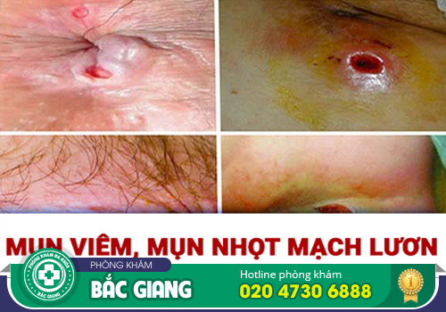 Nhọt mạch lươn - Nguyên nhân, tác hại và cách điều trị