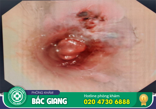 Nội soi hậu môn - Phương pháp chẩn đoán trĩ vô cùng quan trọng