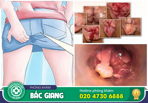 Nội soi trĩ thực hiện như thế nào? Cần lưu tâm gì?