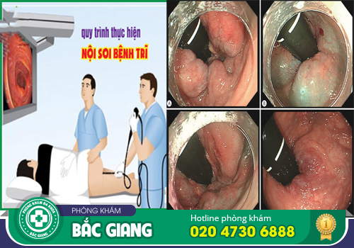 Nội soi trĩ thực hiện như thế nào? Cần lưu tâm gì?