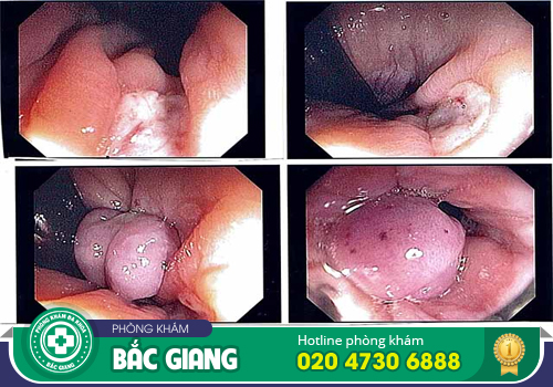 Nội soi trĩ không đau được thực hiện như thế nào?