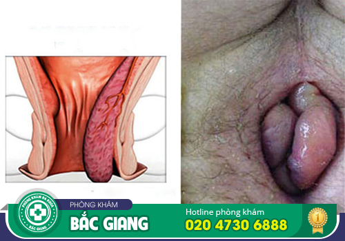 Nội soi trĩ thực hiện như thế nào? Cần lưu tâm gì?