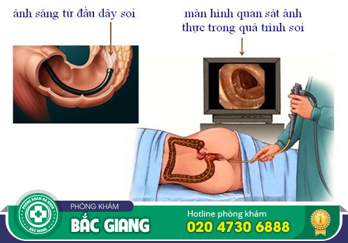 Nội soi trực tràng có đau không? Khi nào cần thực hiện?
