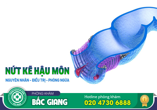 Nứt kẽ hậu môn không phát hiện và điều trị sớm có thể gây biến chứng nguy hiểm