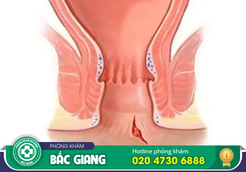 Tổng quan về nứt kẽ hậu môn - Nguyên nhân, triệu chứng cùng giải pháp khắc phục