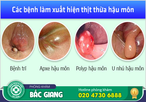 Thịt thừa lỗ hậu môn có nguy hiểm không?