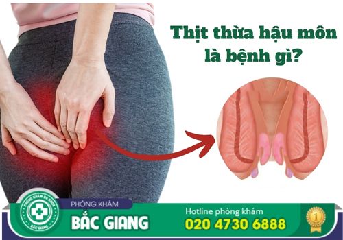 thịt thừa hậu môn