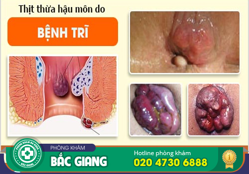 Có cục thịt dư hậu môn có phải bệnh trĩ không?