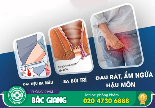 Những triệu chứng bệnh hậu môn trực tràng bạn cần cảnh giác